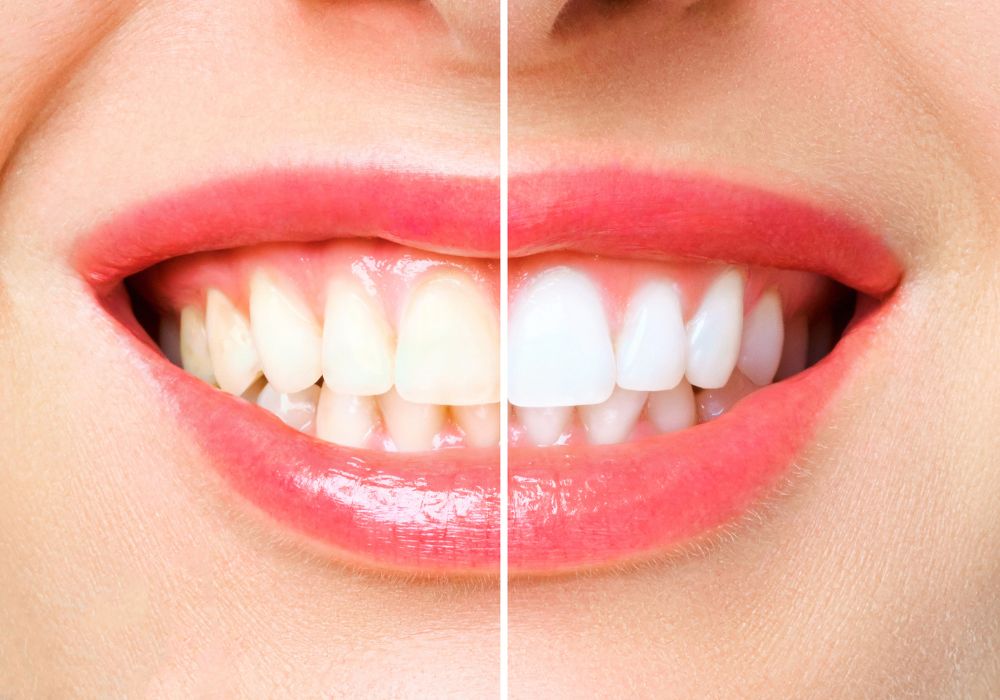 Teeth Whitening Bleaching by 1000 Smiles dental and Implant center