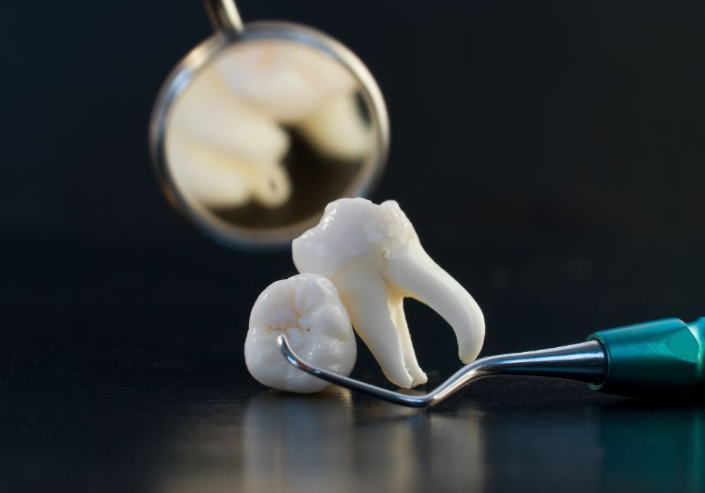 Wisdom Tooth Extraction from our experts at 1000 Dental Smiles and Implant Center